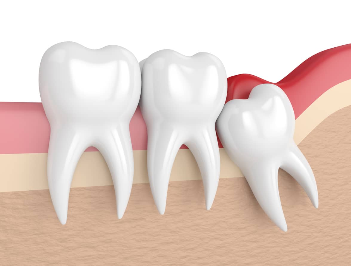 wisdom tooth removal services
