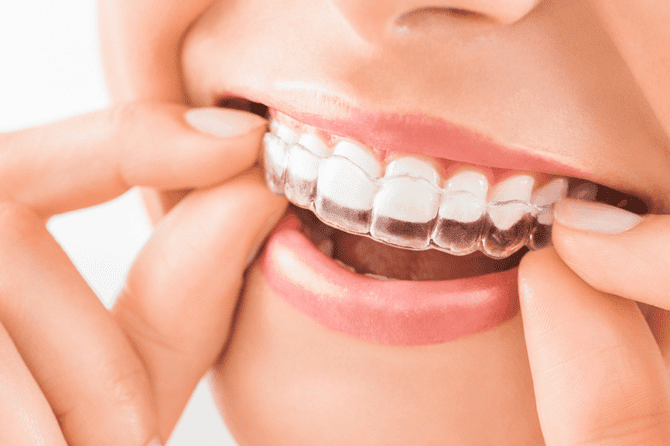 Unlock the Benefits of Invisalign for a Straighter and a More Confident Smile
