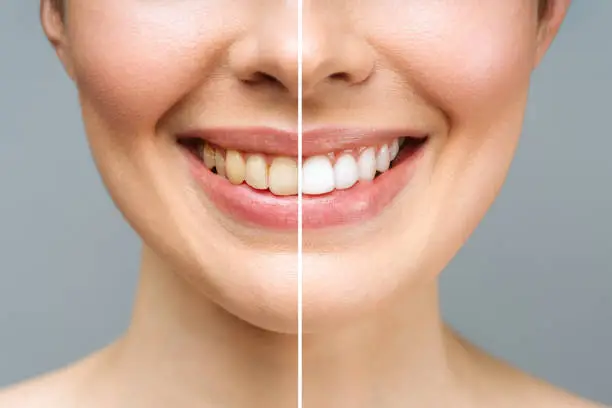 Teeth Whitening: Benefits and Procedure
