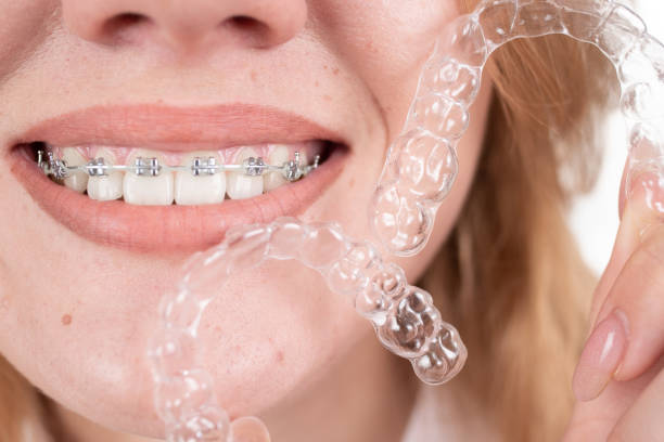 Affordable Invisalign: How to Get a Great Deal Under $1000