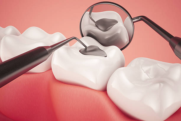 Understanding the Different Types of Tooth Fillings