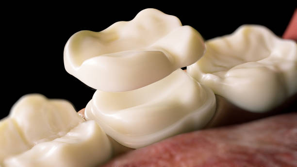 The Key Benefits of Dental Crowns and Bridges