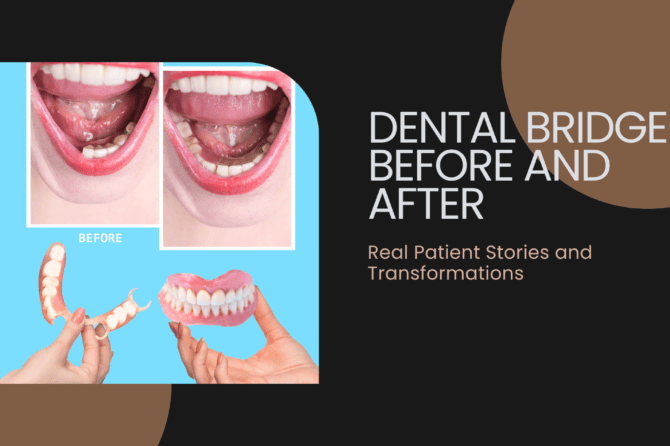 Dental Bridge Before and After Real Patient Stories and Transformations