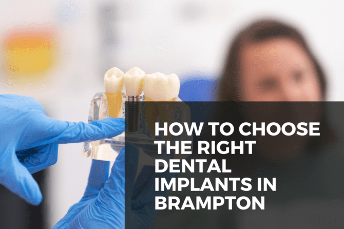 How to Choose the Right Dental Implants in Brampton: A Comprehensive Guide