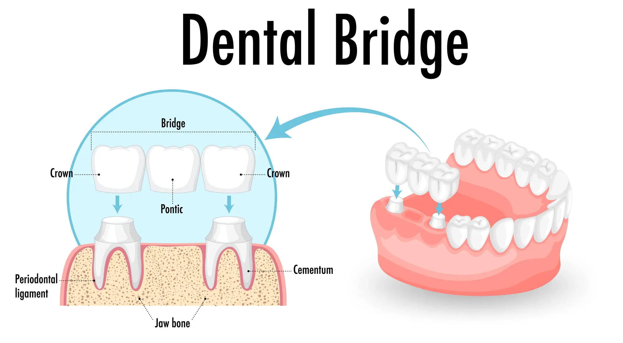dental bridge in brampton