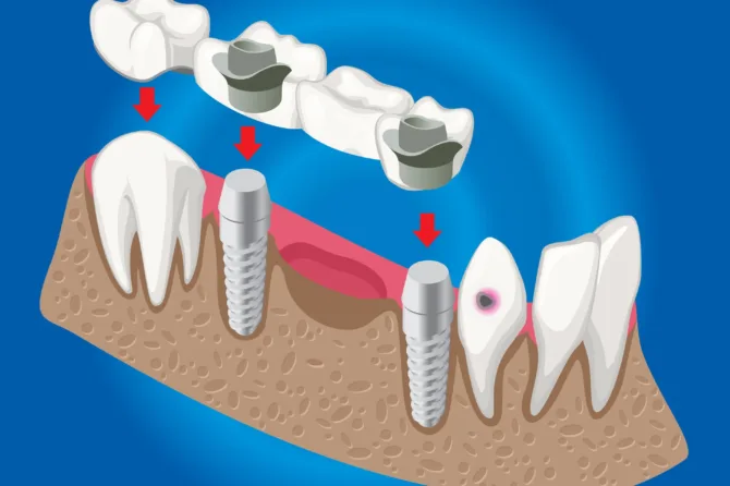 The Ultimate Guide to Understanding Dental Bridges