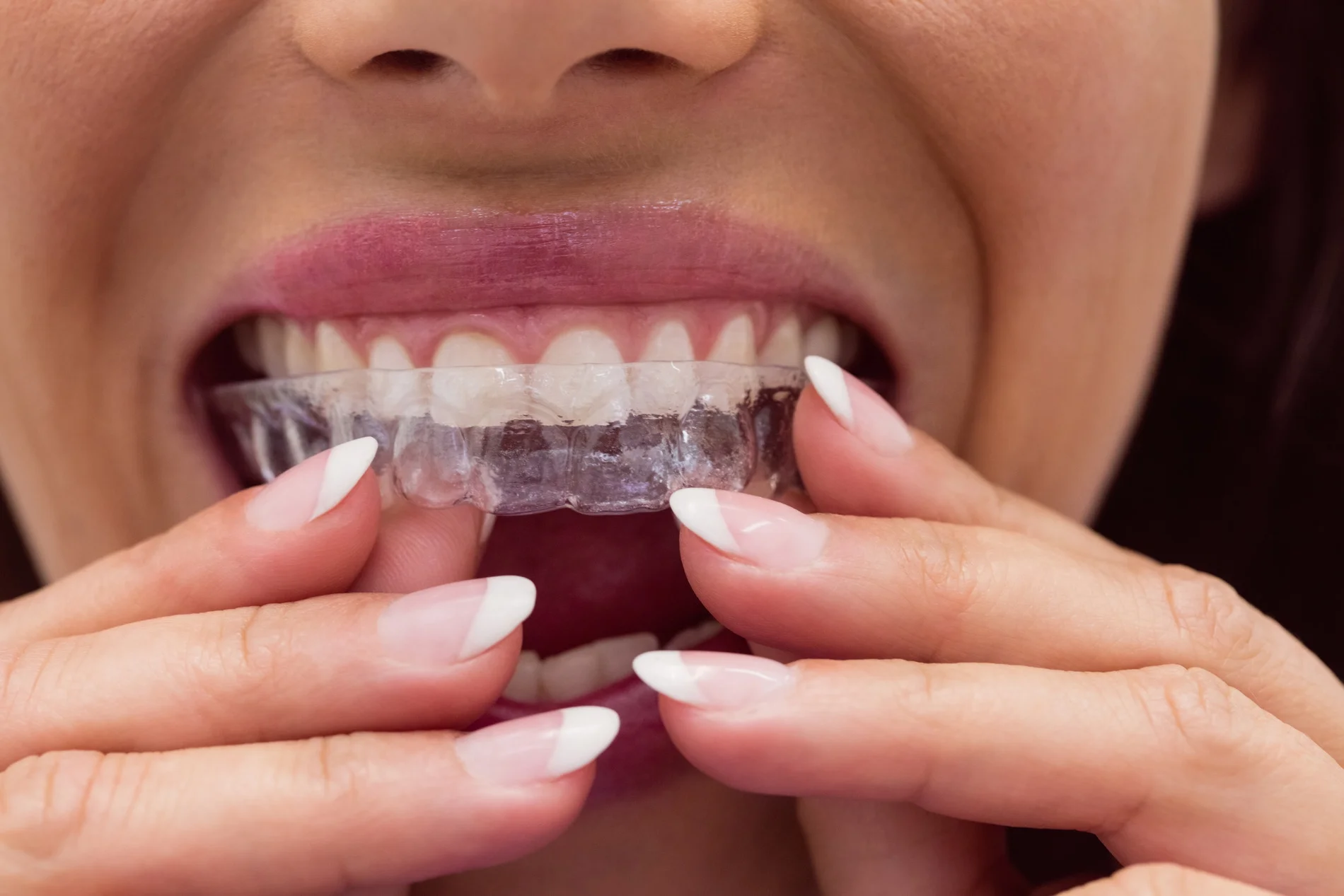 How Invisalign Works: A Step-by-Step Guide to Your Perfect Smile
